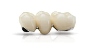 Răng sứ Chrome Cobalt